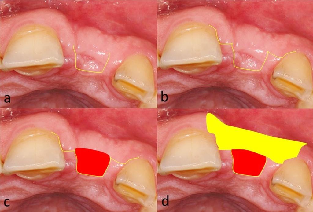 A newly developed by the author, modified surgical protocol was performed for the achievement of ridge augmentation, and obtainment of adequate soft tissue volume and simultaneous with the early
