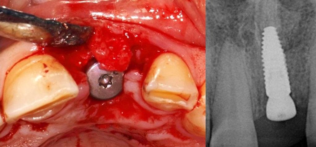 The mesiodistal and orofacial positioning was set with the separation of the U-shaped initial incision, and the coronoapical implant level was defined from the height of the recreated interdental