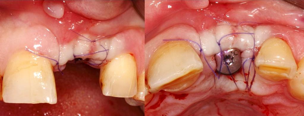 The deepithelized crestal flap was folded buccaly and inserted between the inner surface of the buccal flap and the preserved periosteum layer on the buccal wall of the residual socket, then it was