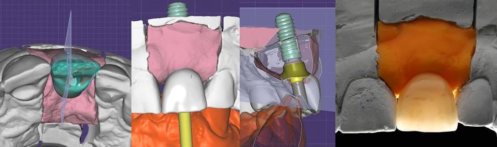 RESULT: The application of this newly developed by the author modification of the surgical protocol allowed precise implant placement consistent with the biological width requirements and