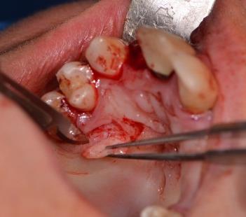 granulation tissue Placement of