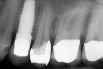 Immediate postoperative radiograph of a NobelDirect one-piece immediate implant placed in a fresh extraction socket in the maxilla.