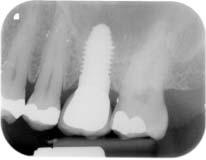 6-month postoperative radiograph of an unloaded NobelDirect one-piece implant placed in the mandible. Note the mesial bone level. Fig 5b.
