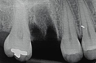 Initial situation Upper molar is extracted atraumatically.