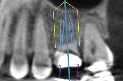 Tooth needs to be extracted due to decay.