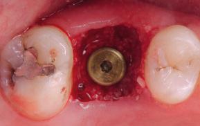 Xenograft material is packed around the implant and covered by a
