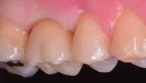 max ceramic crown is cemented to a titanium NobelProcera Abutment to