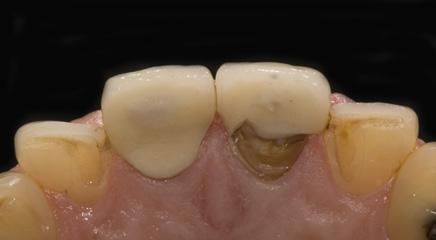 avoid a second surgical operation to place the implant. Treatment in the anterior esthetic zone is particularly challenging.