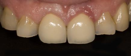 CASE DESCRIPTION Female patient aged 57, receiving treatment for high blood pressure and arthrosis, visits the clinic due to the breakage of the central tooth, on which she had a lithium disilicate