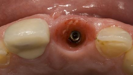 the first restorative option in the anterior esthetic zone.