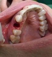 Later on; extraction of the tooth, a good enucleation of the soft tissue in the periapical area of
