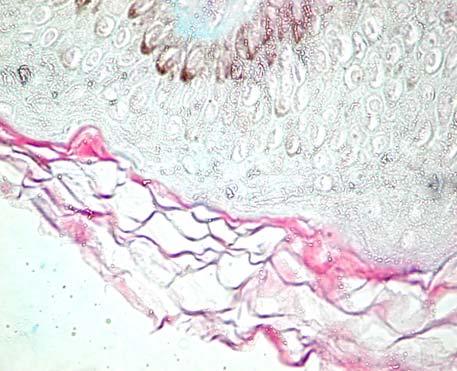 occupied the papillary and reticular superficial dermis.