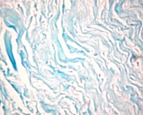 366 Gabriela Ieremia et al. Figure 8 Scleroderma. The thick collagen fibers from the reticular dermis, with heterogenic affinity for the blue alcian. Intense alcianophilia in the collagen fibers.