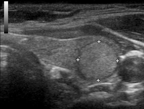 on ultrasound represents