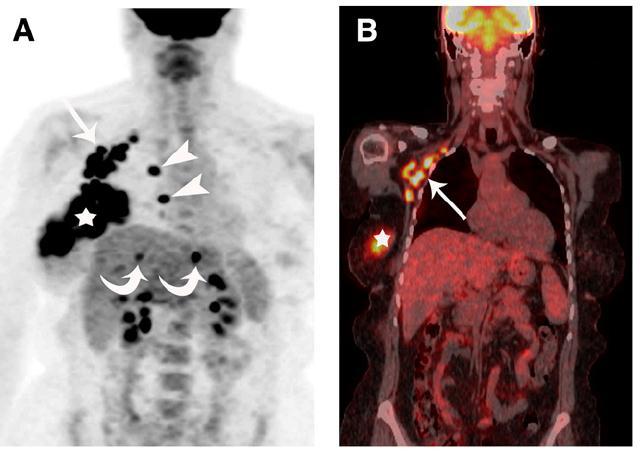 ipsilateral axillary nodal involvement in 90%, ipsilateral subpectoral nodes in 44%, and distant