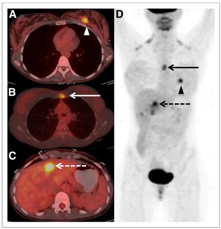 Retrospective Analysis of 18F-FDG PET/CT for Staging Asymptomatic Breast Cancer