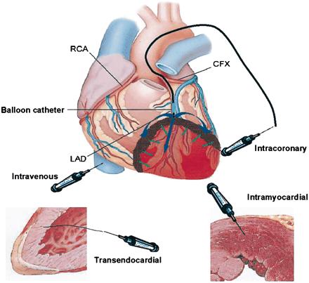 Slide 13 13 Possible routes for cell therapy to the heart RCA CFX Balloon catheter LAD Intravenous Intracoronary Intramyocardial Transendocardial Strauer BE, Kornowski R. Circulation 2003;107:929-34.