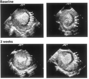 Slide 30 30 BMCs reduce perfusion defect in ischemic pig hearts Kamihata H et al. Circulation. 2001;104:1046-52.