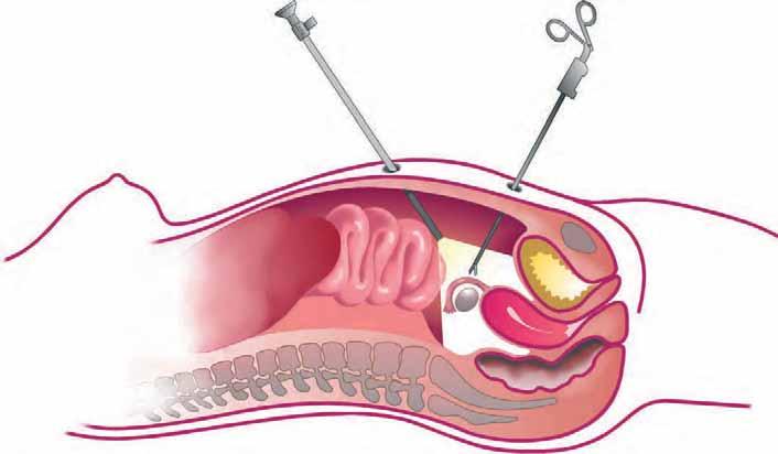 Technique and Procedure Laparoscopy (Intra-Abdominal Keyhole Surgery) 1 2 Procedures Laparoscopy is a procedure that allows intra-abdominal surgery to be performed with the help of special optical
