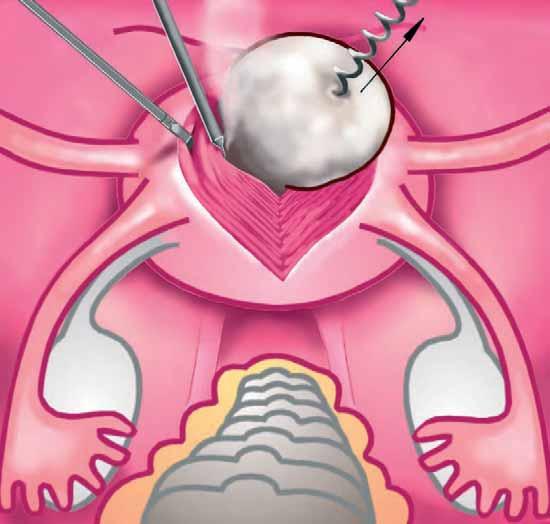 Treatment of Myomas Surgical Removal of Myomas Endometriosis Myomas of different sizes can be