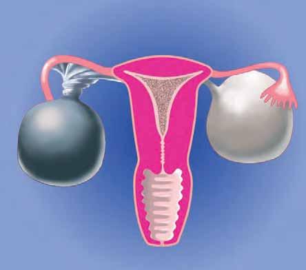 Assessment of Ovarian Cysts Ovarian Cysts the