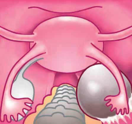 Ovarian cysts are frequently symptomatic and