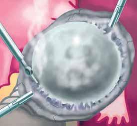 Treatment of Ovarian Cysts