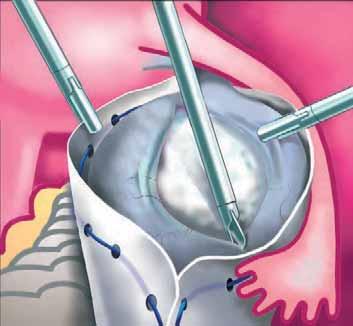 Treatment of Ovarian Cysts Surgical Removal of Ovarian Cysts with the help of a synthetic extraction bag to ensure that none of the