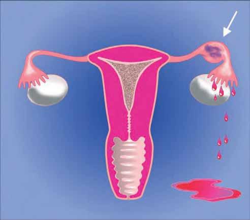 Assessment of Tubal Pregnancy Tubal Pregnancy In approx.