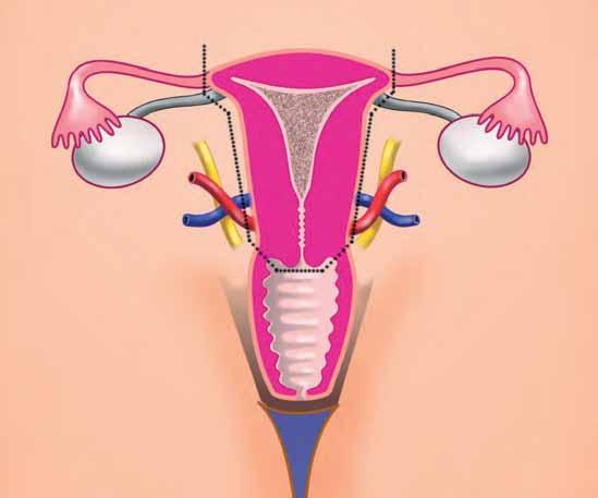 the surgical removal of the uterus.