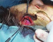 The Journal of Craniofacial Surgery Volume 26, Number 3, May 2015 Temporal Brow Lift Surgery Techniques FIGURE 1. Intraoperative photograph of the Endotine Ribbon technique.