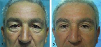 Suture fixation in temporal brow lift surgery before (A) and after 1 year (B) of follow-up. with the suspension suture instead seems to be both temporally and spatially limited.