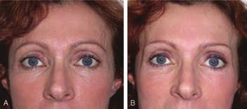 Moreover, after 6 months, a certain degree of relapse is visible in the medial and lateral region and the brow drop is further increased after 1 year, giving rise to a relatively poor long-term