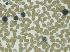 LEUCOGNOST LEUCOGNOST ALPA Cytochemical staining for the differentiation of leukaemia and myelodysplastic syndromes In the clinical routine examination are the main indications for accomplishment of