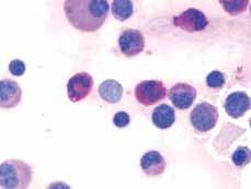 32) Periodic-Acid-Schiff-reaction Positive reaction with cells of the myeloic line in the bone marrow (Magnification: 1000 x 0.