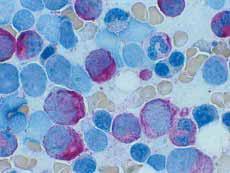 Detection of the chloroacetateesterase (specific esterase) in leukocytes to the delimitation acute myelomonocytic leukaemia (M4Eo) and hypergranular promyelocytic leukaemia (M3) from other leukaemia.