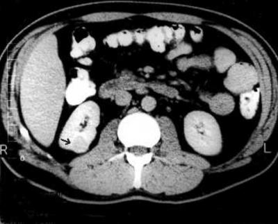the collecting system. A CT scan of the abdomen showed multiple calculi within the pelvis of the left kidney and a 2.0 cm mass in the lower pole of the right kidney (figure 1). Figure 1 Figure 1.