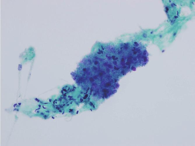 Sclerosing PEComa of the Lung 239 uoles (Fig. 1). Nuclear pleomorphism was minimal. Neither necrosis nor mitotic figures was observed. Some of the clusters had thin vessel-like structures within (Fig.
