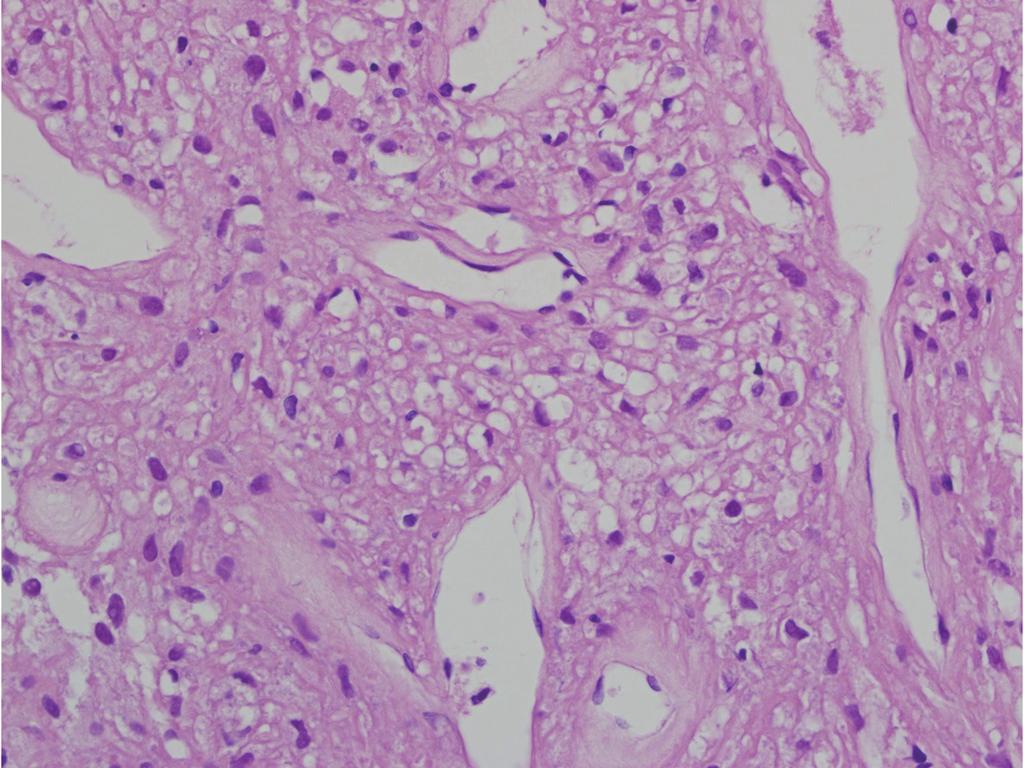 On light microscopy, the histologic findings of the surgical specimen were similar to those of the gun-biopsied specimen.