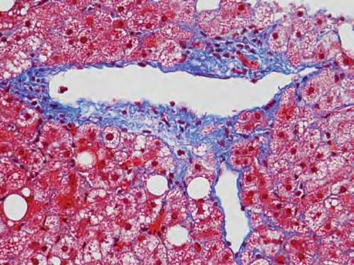 Trichrome stained liver showing fibrous tissue. The fibrous tissue is stained blue while the cytoplasm of hepatocytes are stained red.