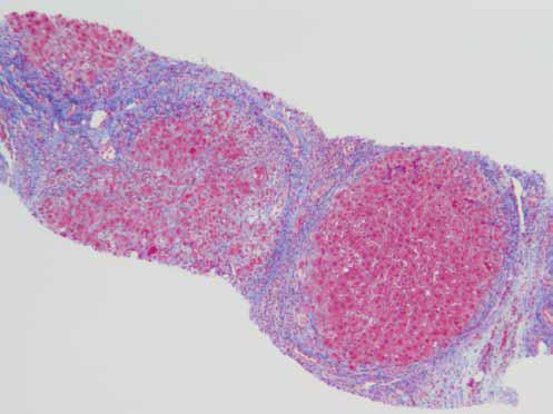Trichrome stain showing cirrhotic liver.