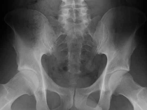They most often describe a deep discomfort in the anterior groin, and occasionally the pain may be directly lateral (greater trochanter area), or deep within the buttocks.