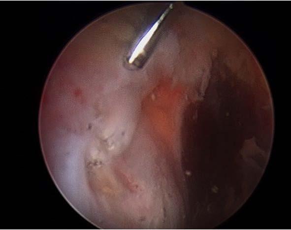 Hip Recalcitrant trochanteric bursitis Gluteal tears Hip