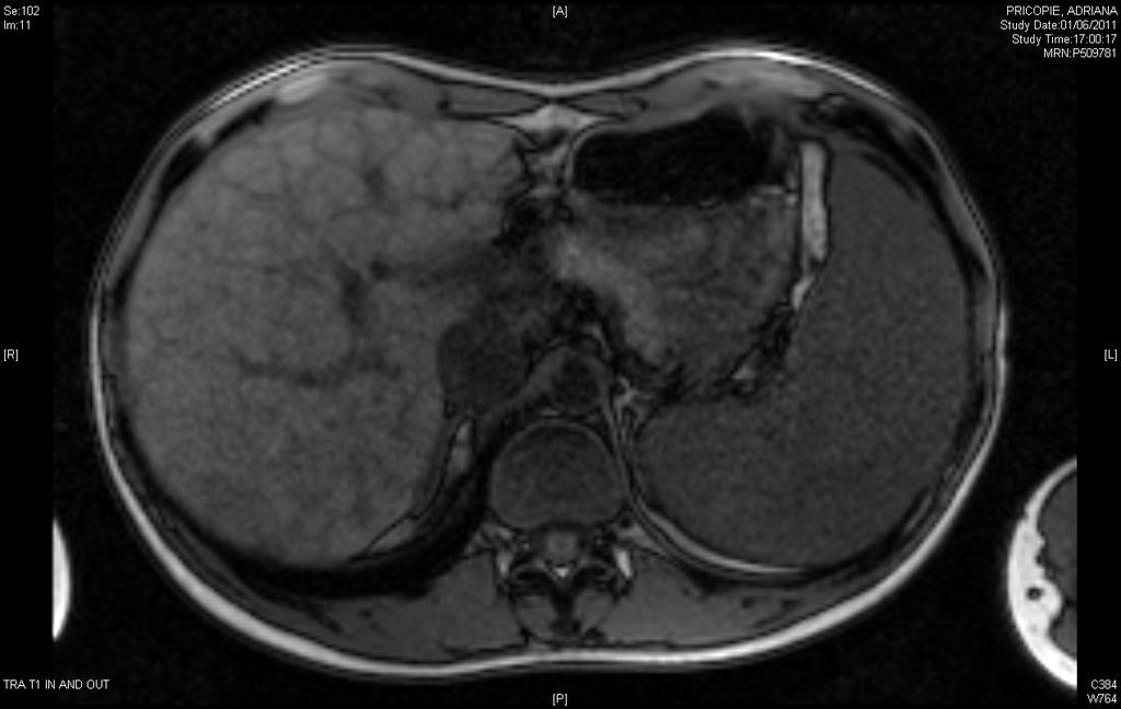 MRI: cirrhosis with portal hypertension HDV What is it?