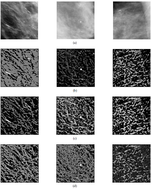 Analysis of Mammograms using Texture Segmentation Table 1. Number of patterns assigned to Q1 and Q0.