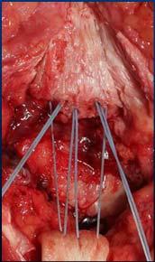 patellar tendon rupture Repair (primary suture) failed at 2