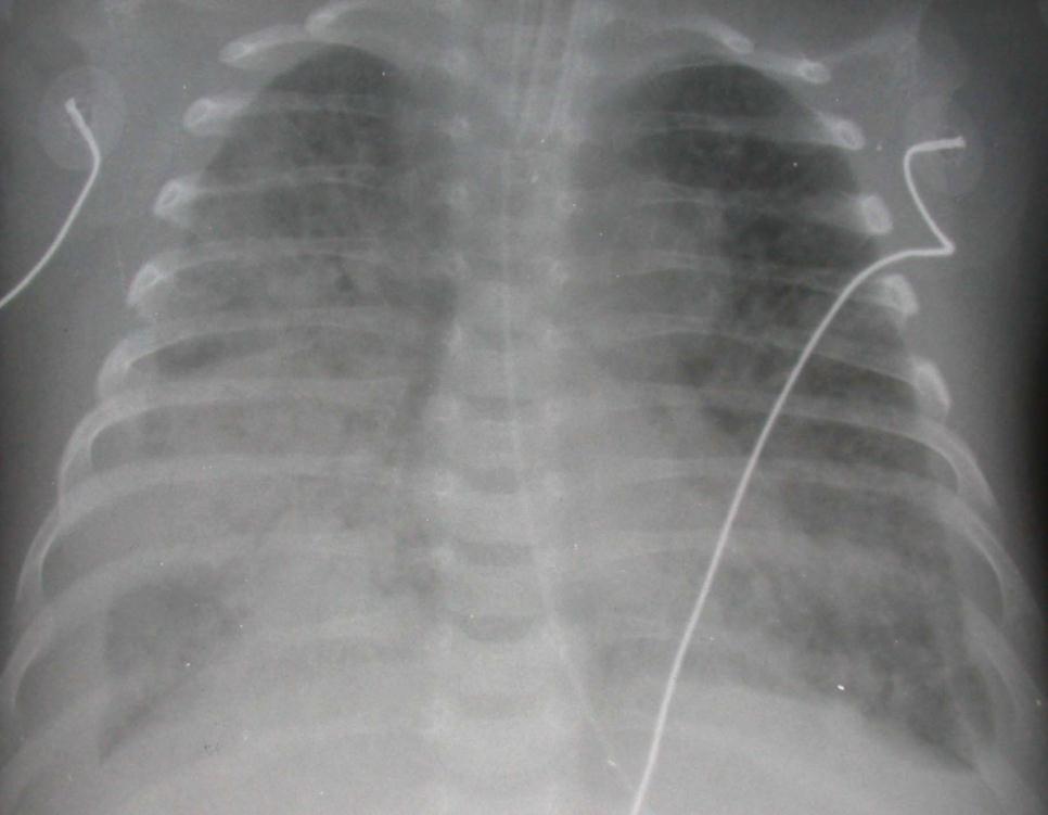 Congenital TB Rare form of transmission Chest radiograph may resemble