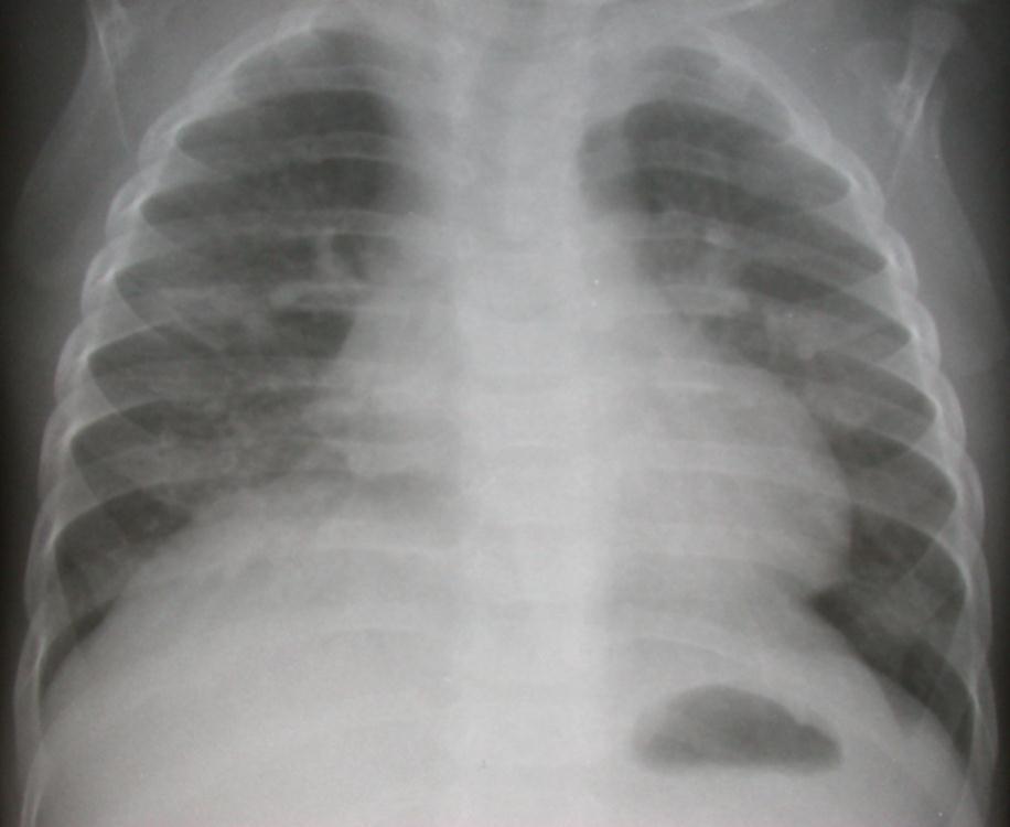Lymphadenopathy Hallmark of primary TB Only radiologic finding in 50% More common < 5 yrs of age