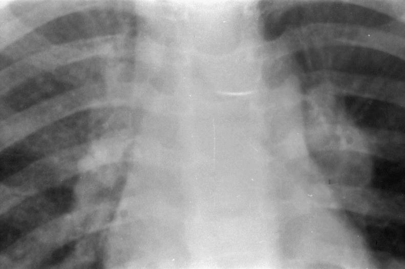 Bronchial Compression/Endobronchial Granuloma Penetration of Adjacent Spaces Pleural effusion Unilateral = direct spread