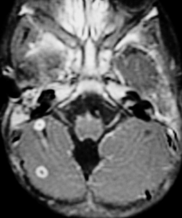 TB Meningitis Diffuse most common CT Non-contrast 50% show increased density in basal